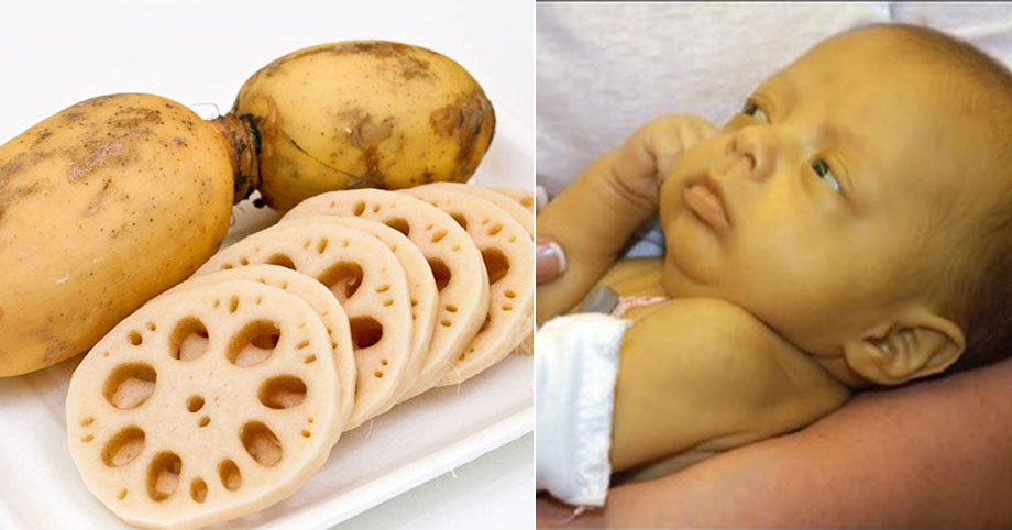 3 thực phẩm giúp ngăn ngừa vàng da cho trẻ sơ sinh, mẹ bầu ăn vào lợi cả đôi đường