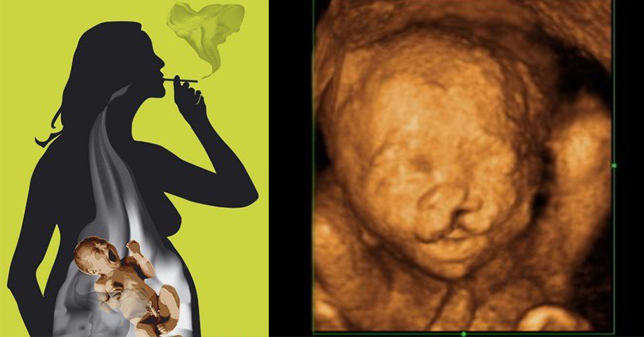 Con trong bụng đạp liên tục mẹ tưởng khỏe, siêu âm mới biết bị dị tật do khói thuốc